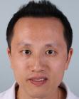 After Hair Transplant &nbsp;Front